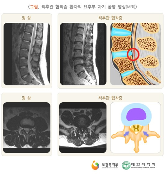 척추관 협착증 환자의 요추부 자기 공명 영상(MRI) 이미지 / 출처 : 보건복지부