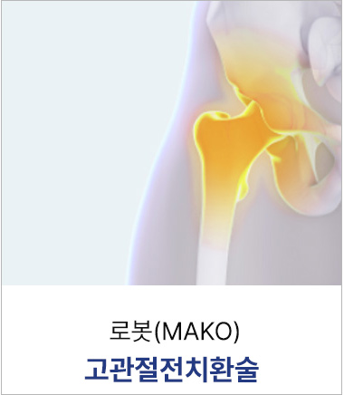 로봇(MAKO)고관절전치환술