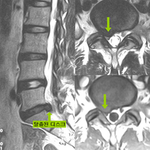 허리디스크 이미지 / 출처 : 대한정형외과 학회