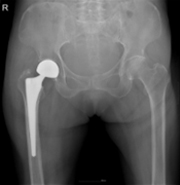 고관절 인공관절반치환술 / (출처 : 대한정형외과 학회)
