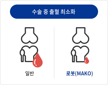 기존 인공관절수술과 로봇 인공관절수술의 차이점